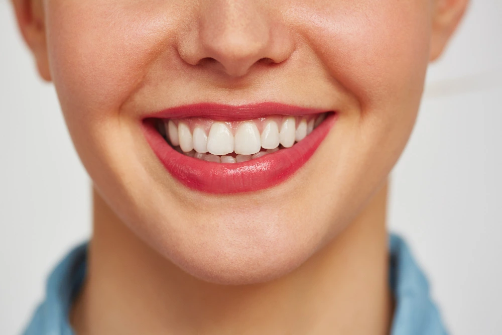 Sonrisa gingival
